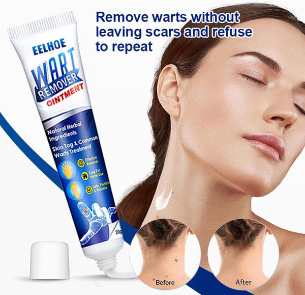 مزيل الثؤلول لطيف لازالة علامات الجلد